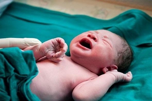 علت تولد نوزاد سندرم داون، شایع ترین ناهنجـاری کروموزومـی
